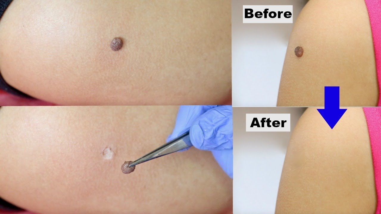Mole Removal dubai